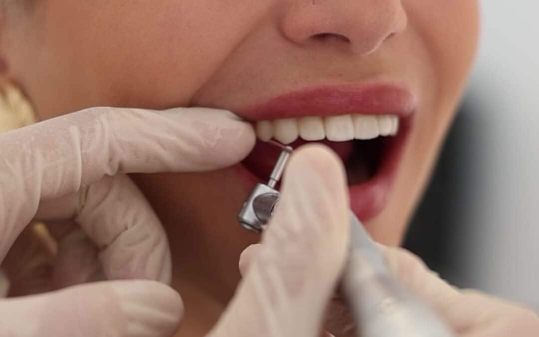 ¿Qué tipos de carillas dentales existen y cuál es la mejor opción?