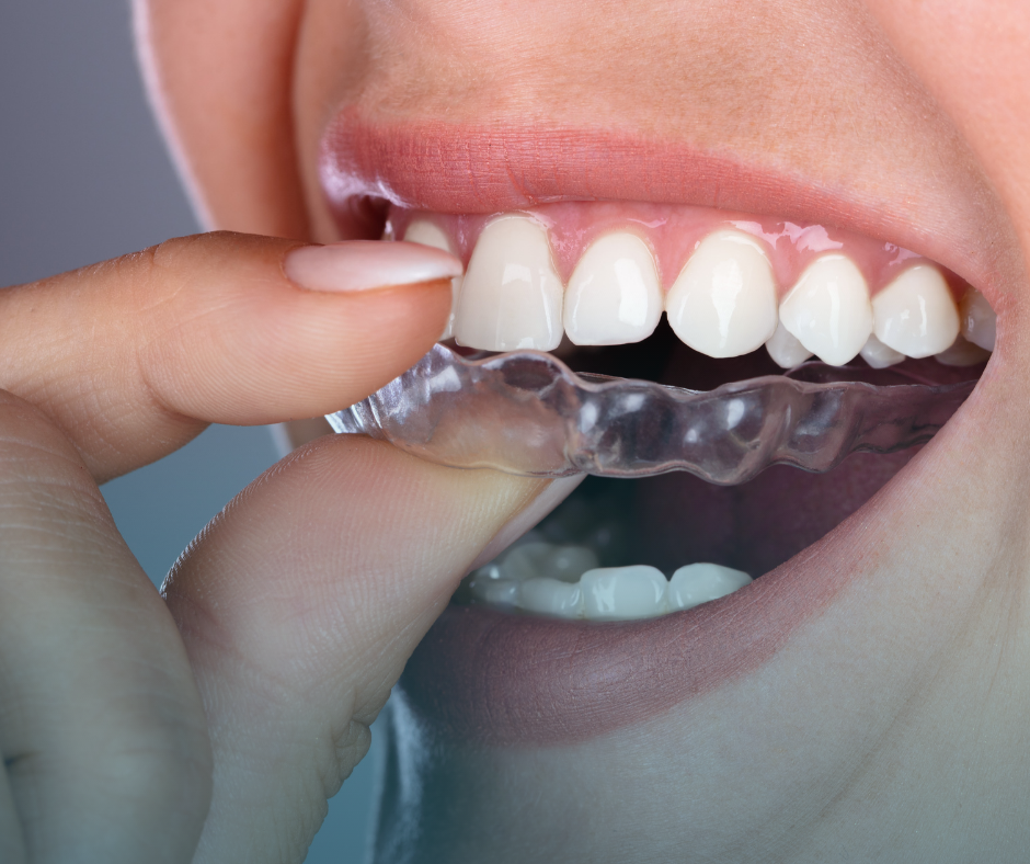 ferula de descarga para tratar el bruxismo