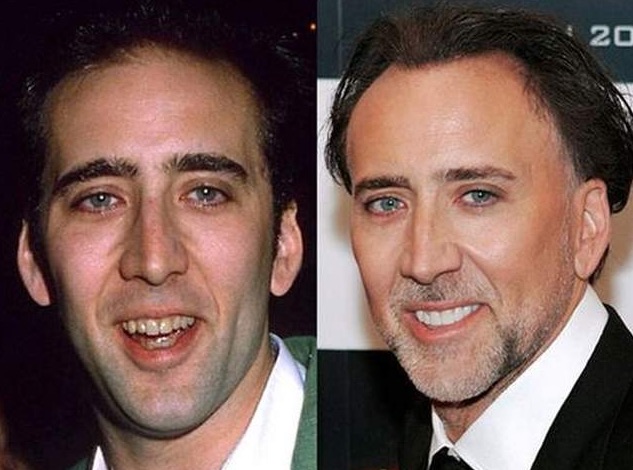 comparacion de Nicolas Cage antes y despues de tener carillas dentales